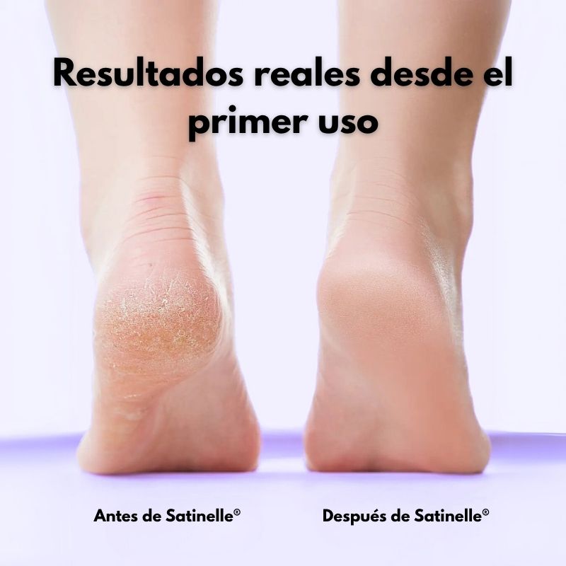 Satinelle® Eliminador Eléctrico de Callos