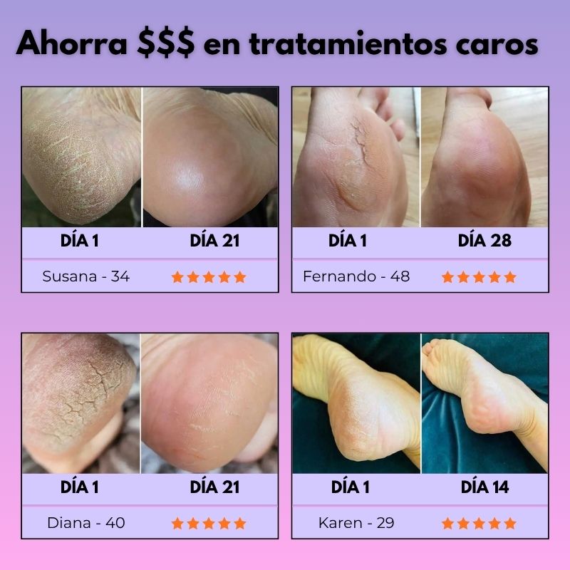 Satinelle® Eliminador Eléctrico de Callos